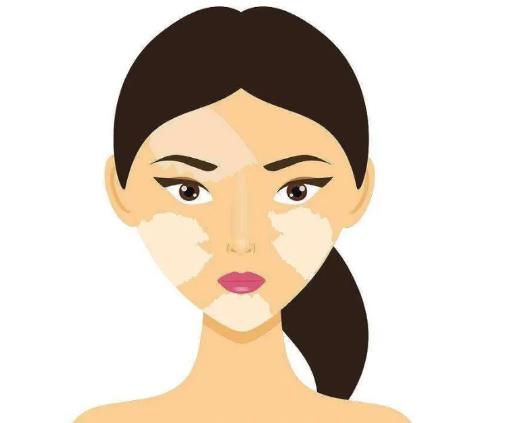 女性白癜风治疗的方法