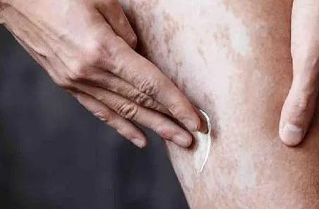 南宁白点癜风怎么治疗好?