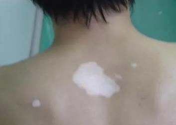 激光治好白癜风要多久?